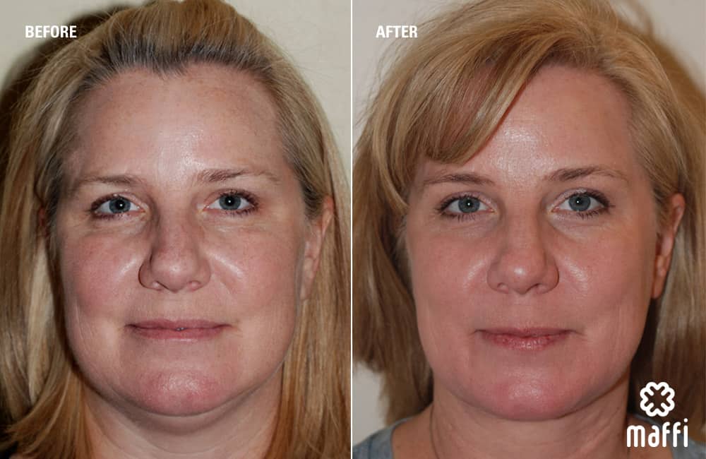Before After Img