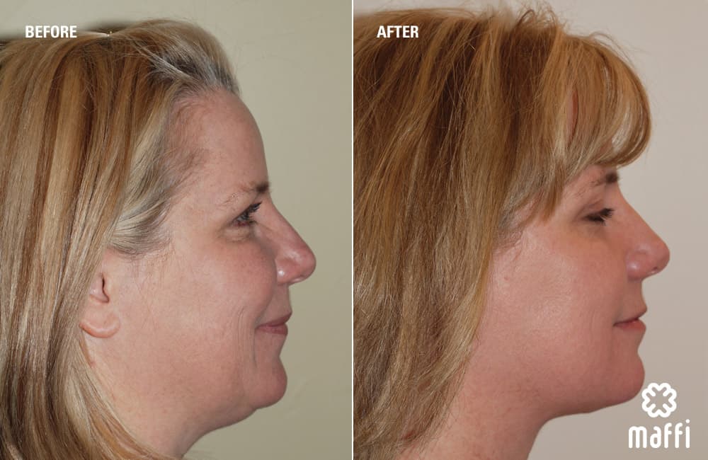 Before After Img