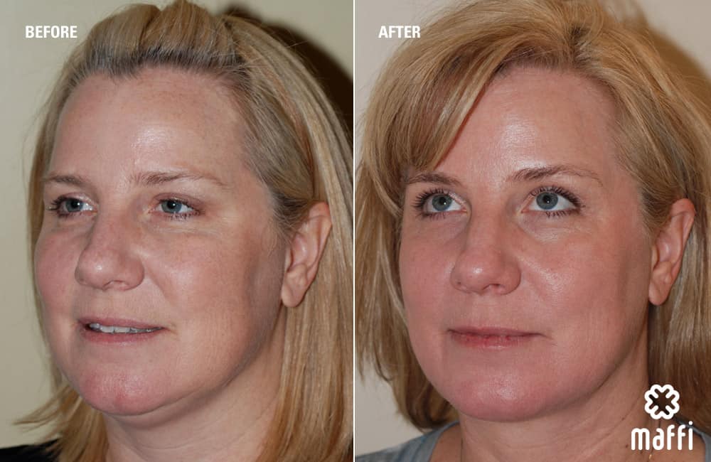 Before After Img