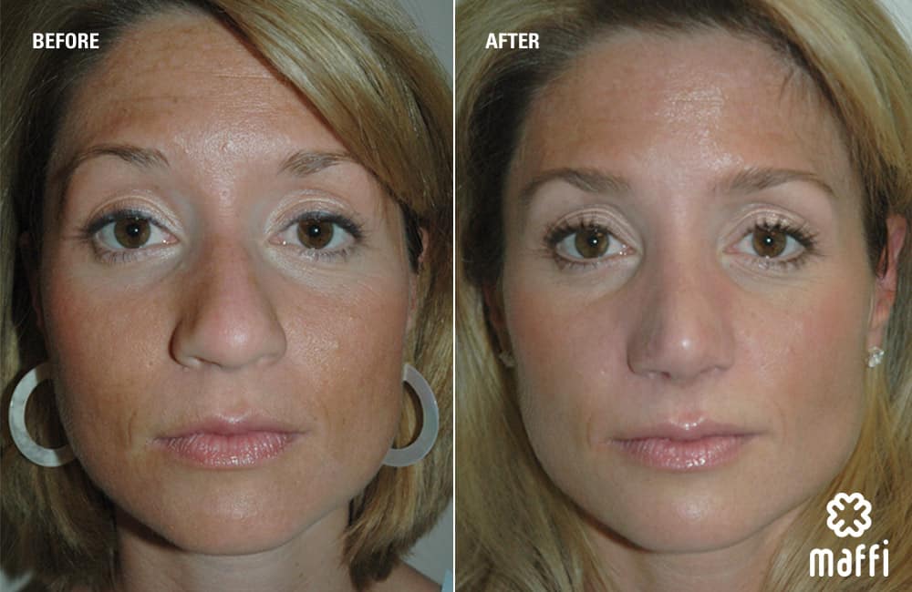 Before After Img
