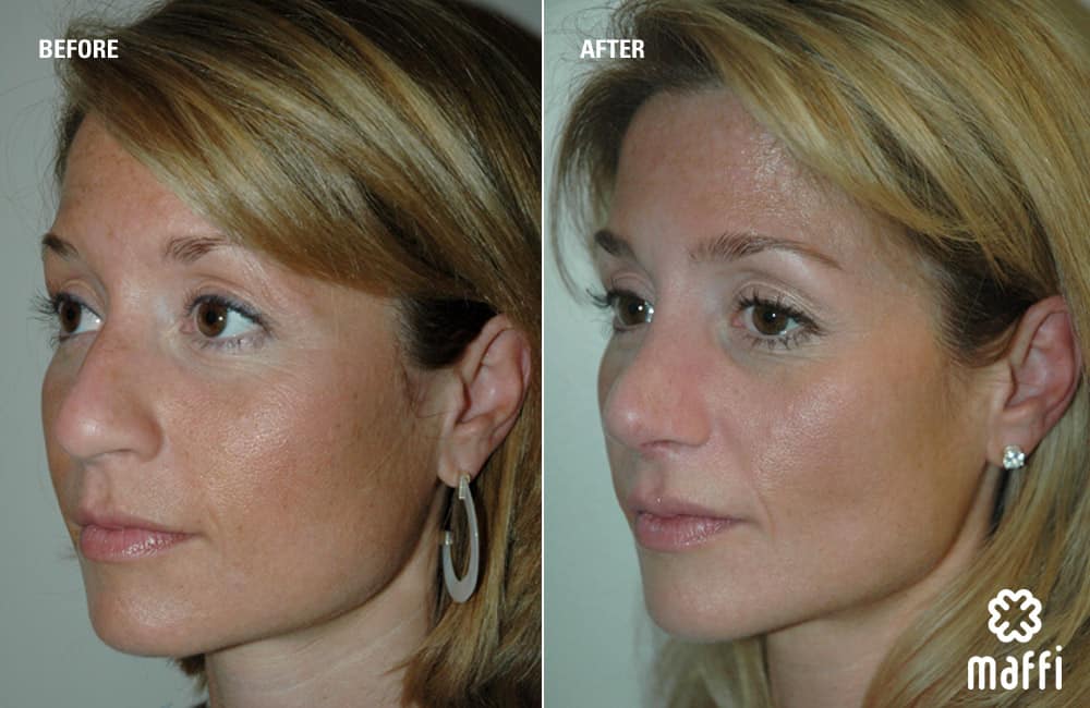 Before After Img