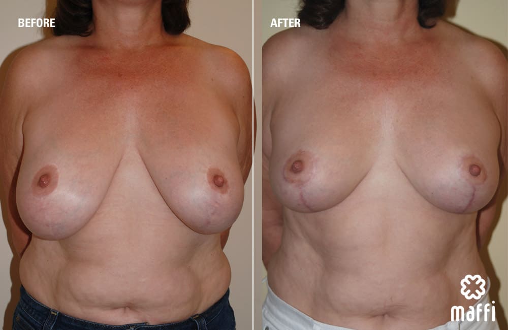 Before After Img