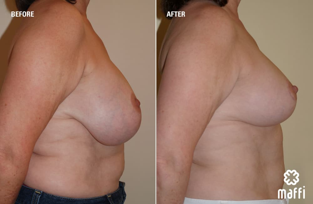 Before After Img