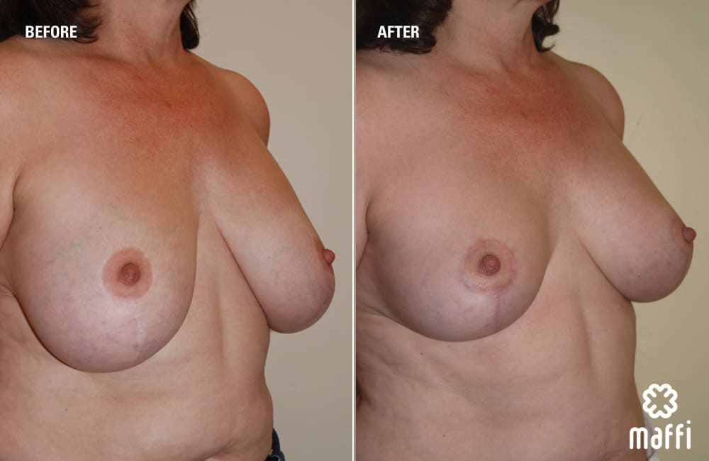 Before After Img