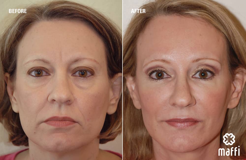 Before After Img