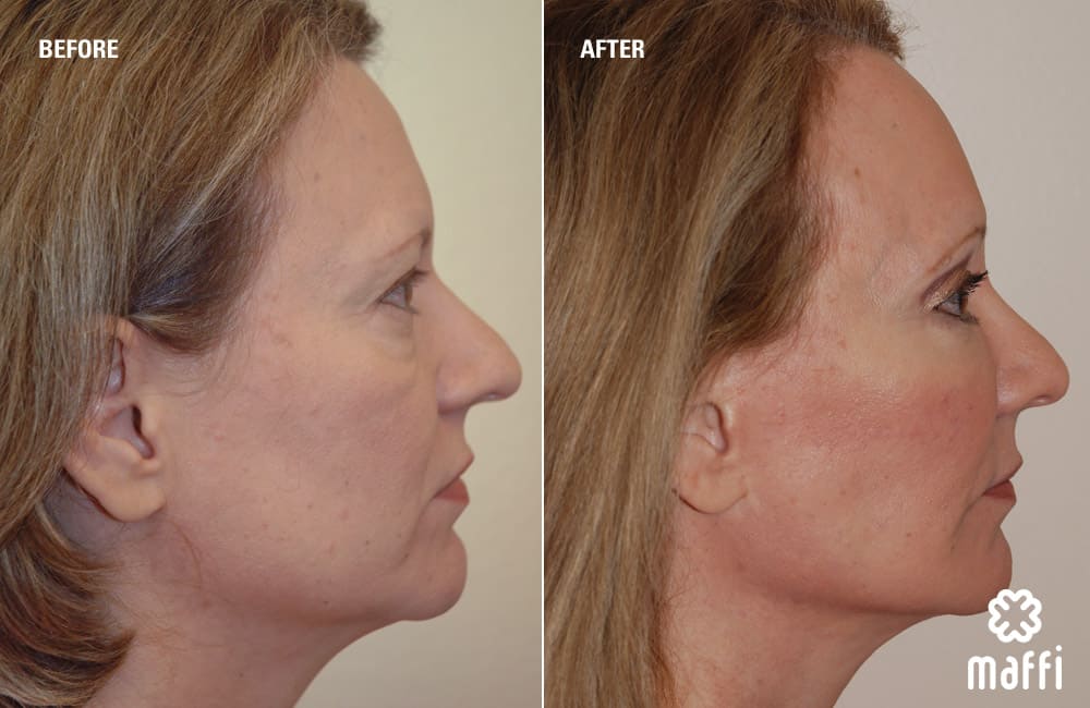 Before After Img