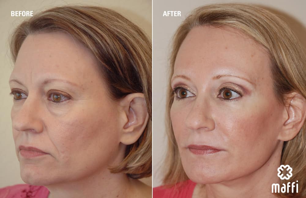 Before After Img
