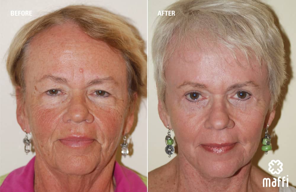 Before After Img