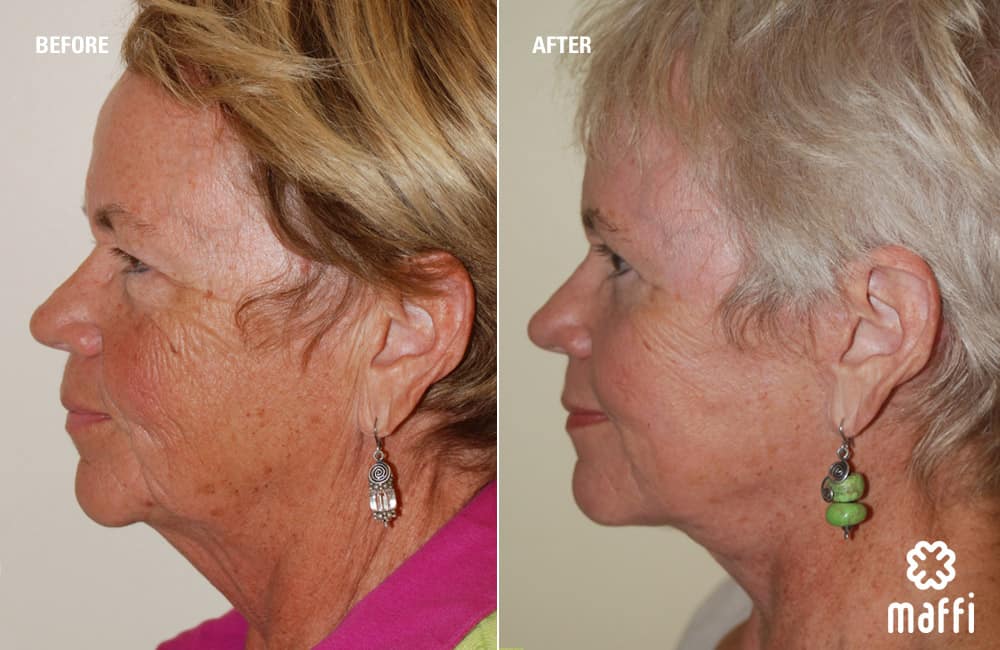 Before After Img