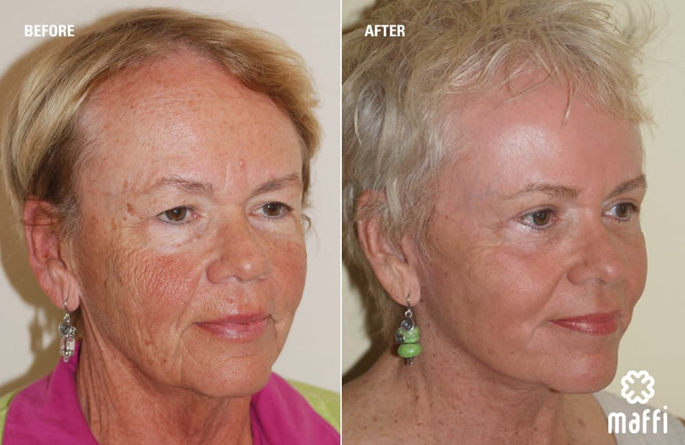 Before After Img