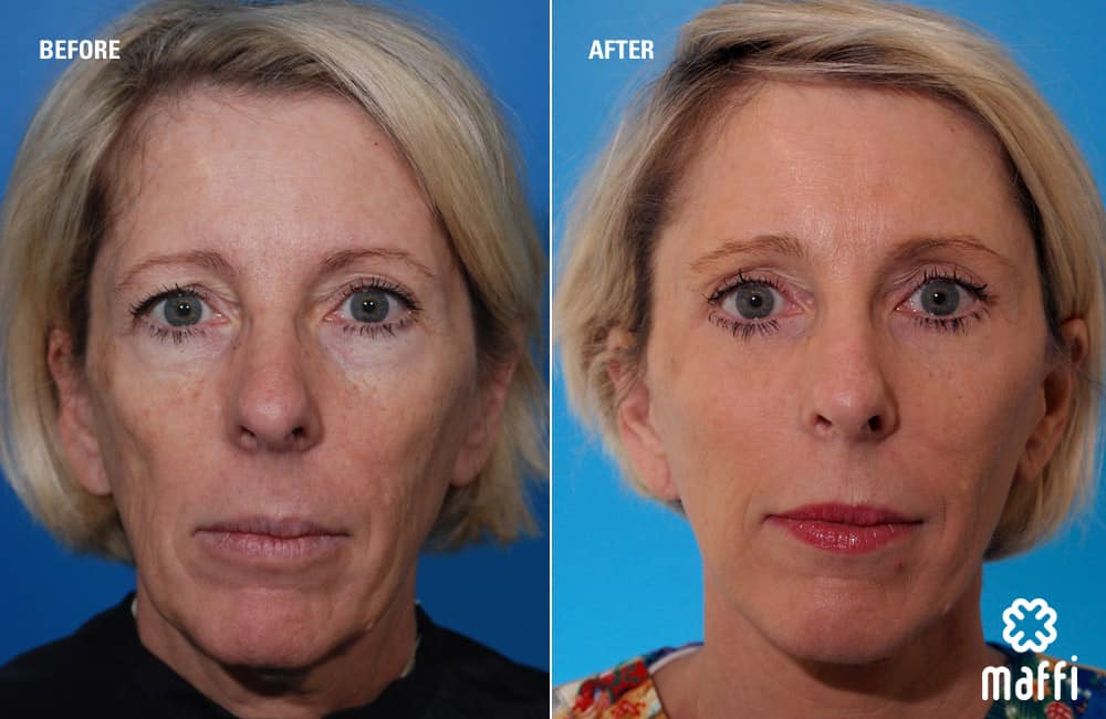 Before After Img