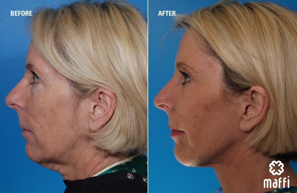 Before After Img