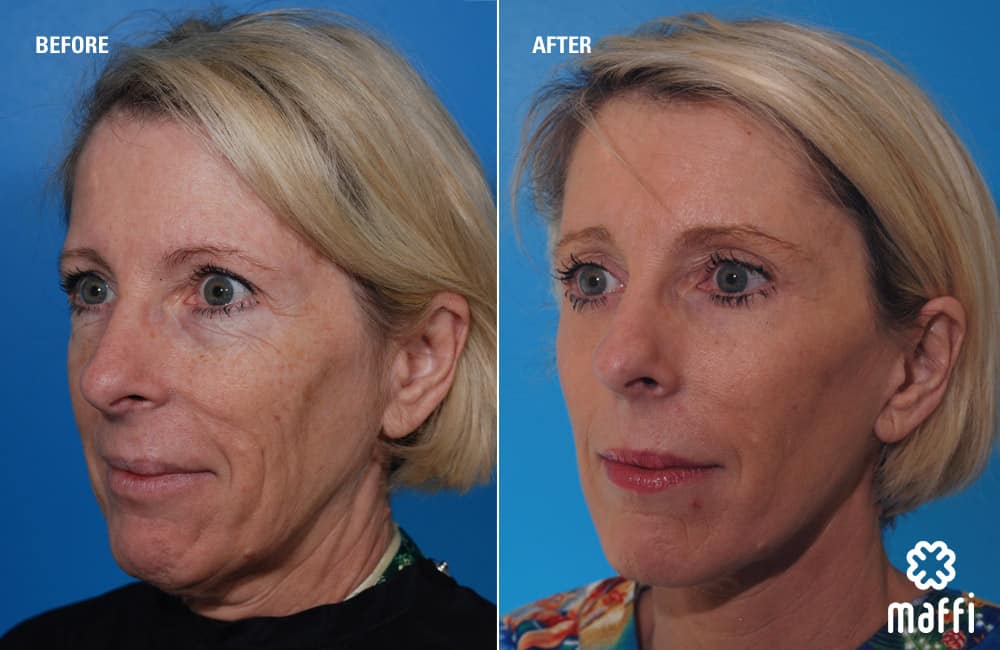 Before After Img