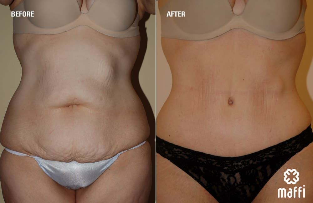 Before After Img