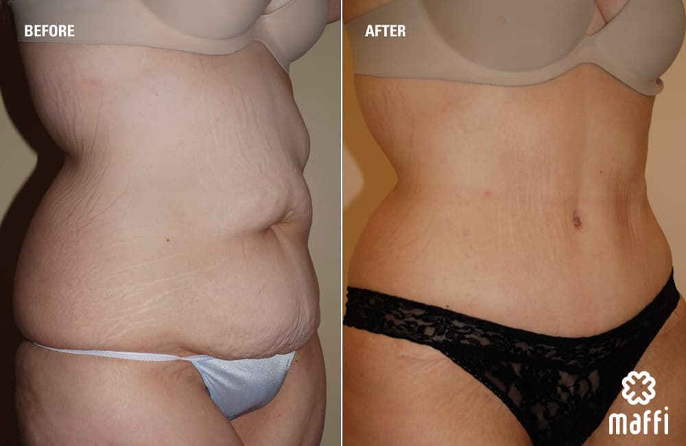 Before After Img