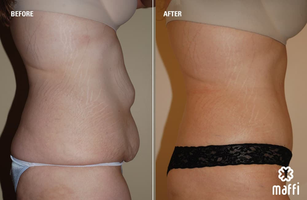 Before After Img