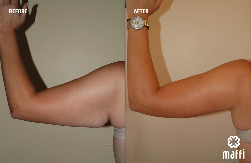Before After Img