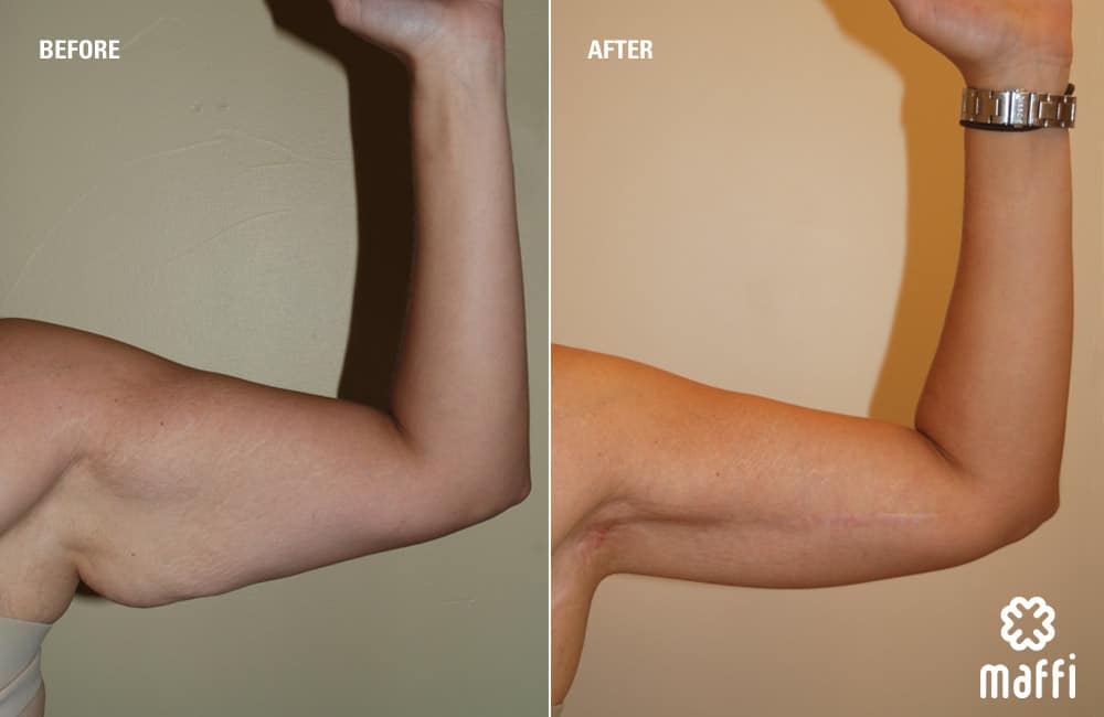 Before After Img