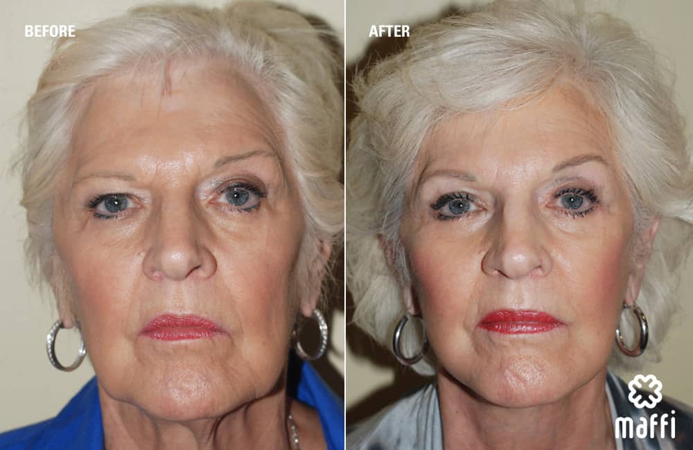 Before After Img