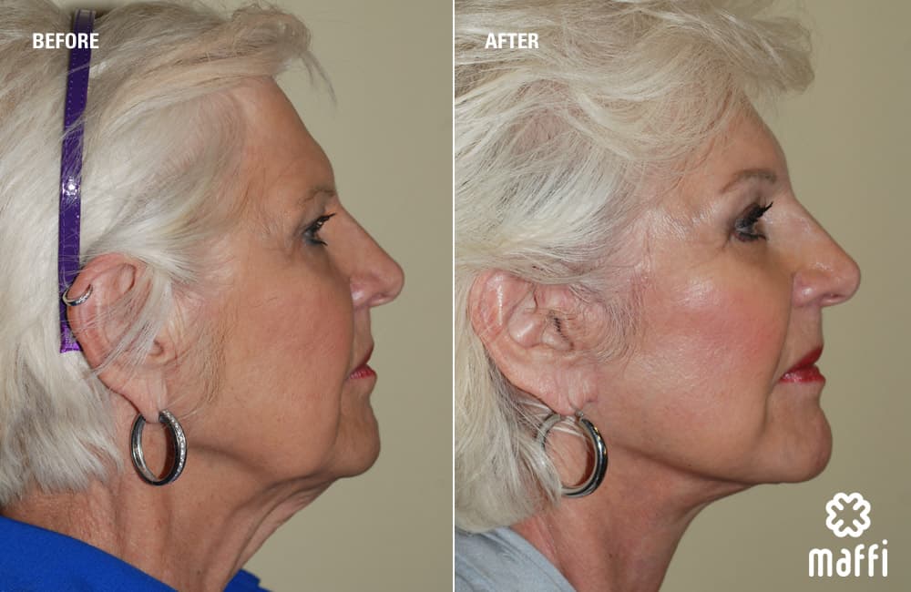 Before After Img