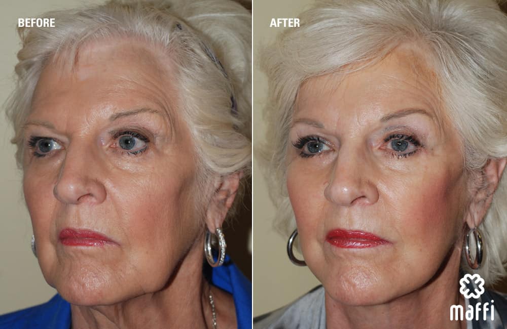 Before After Img