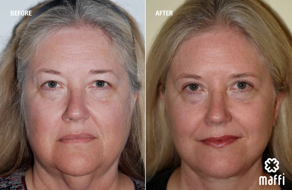 Before After Img