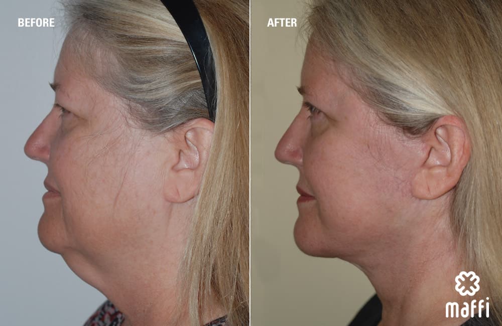 Before After Img