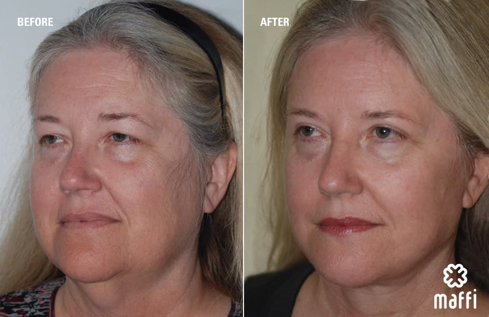Before After Img