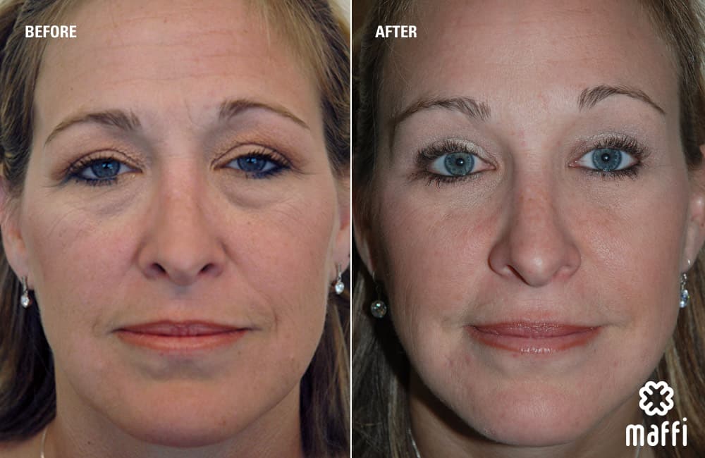 Before After Img