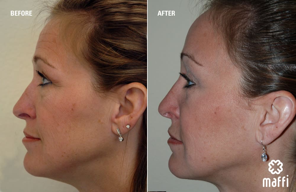 Before After Img
