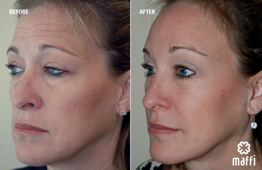 Before After Img