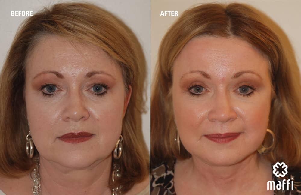 Before After Img