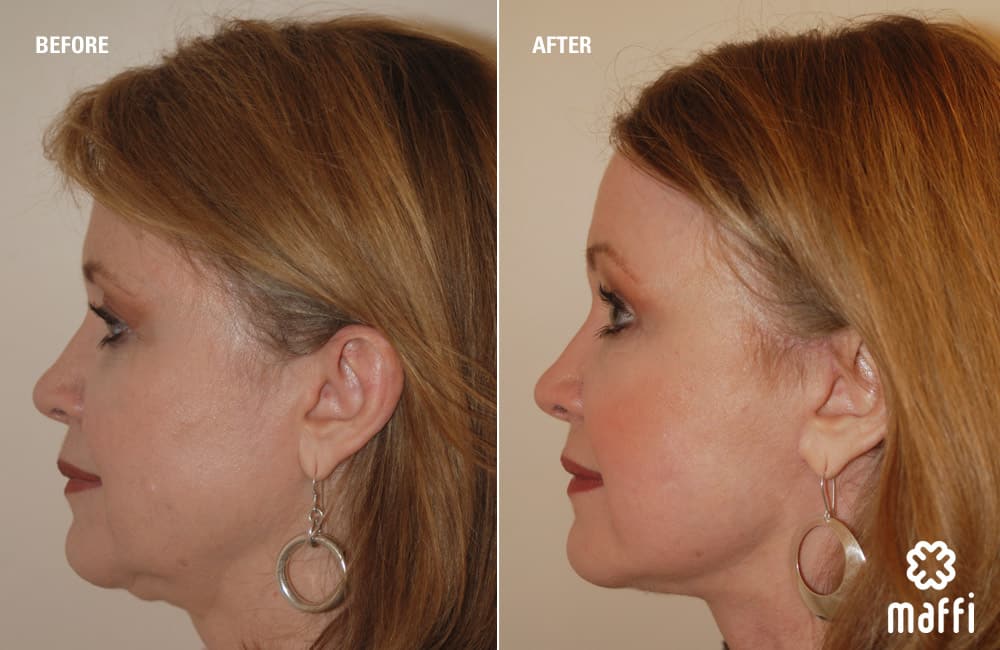Before After Img
