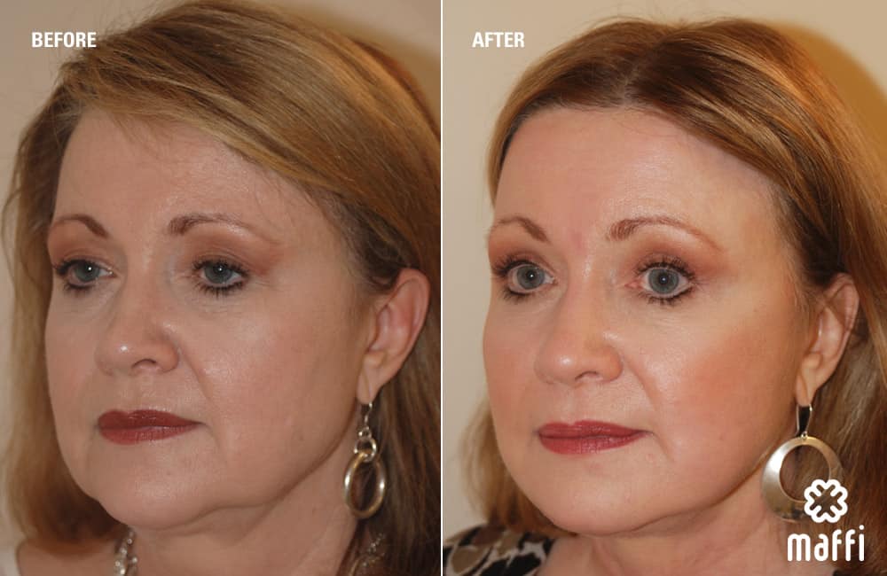 Before After Img