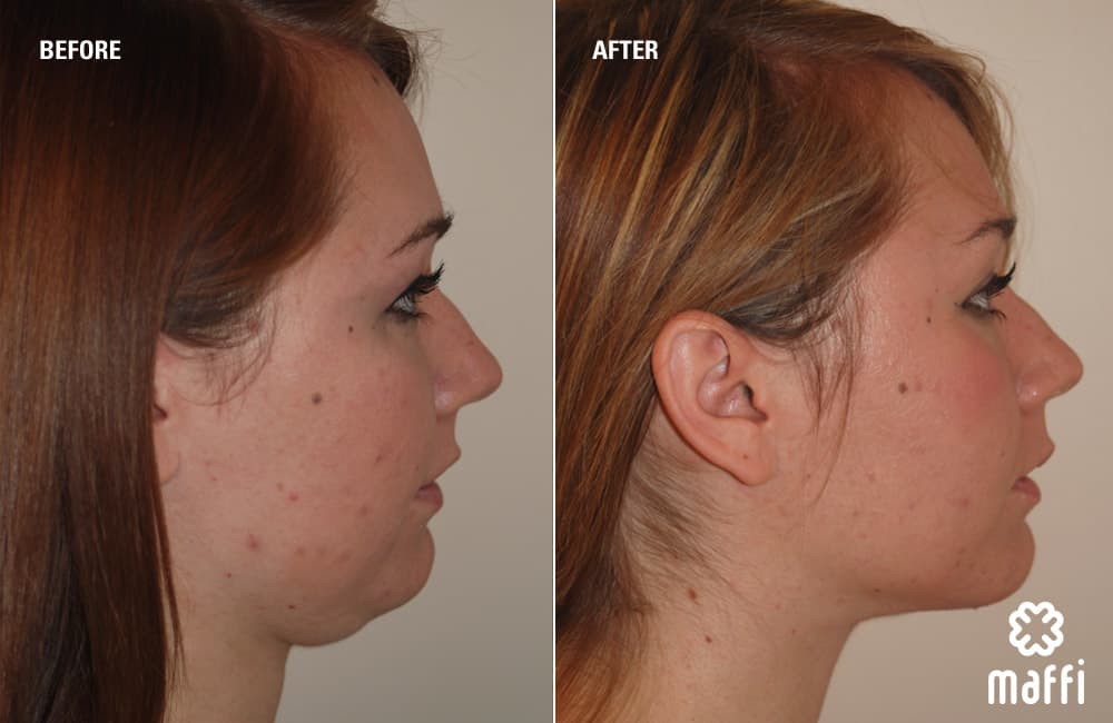 Before After Img