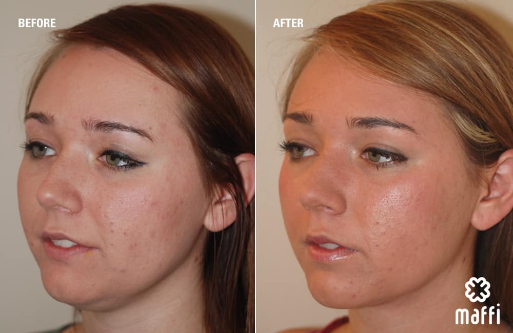 Before After Img