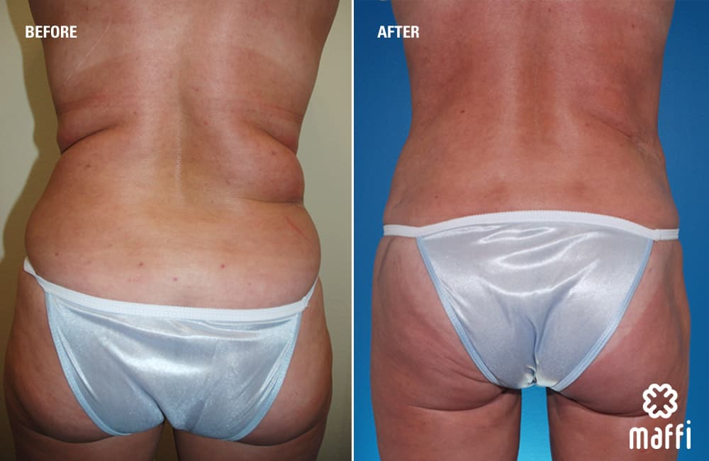 Before After Img