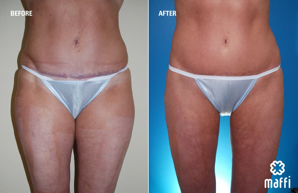Before After Img
