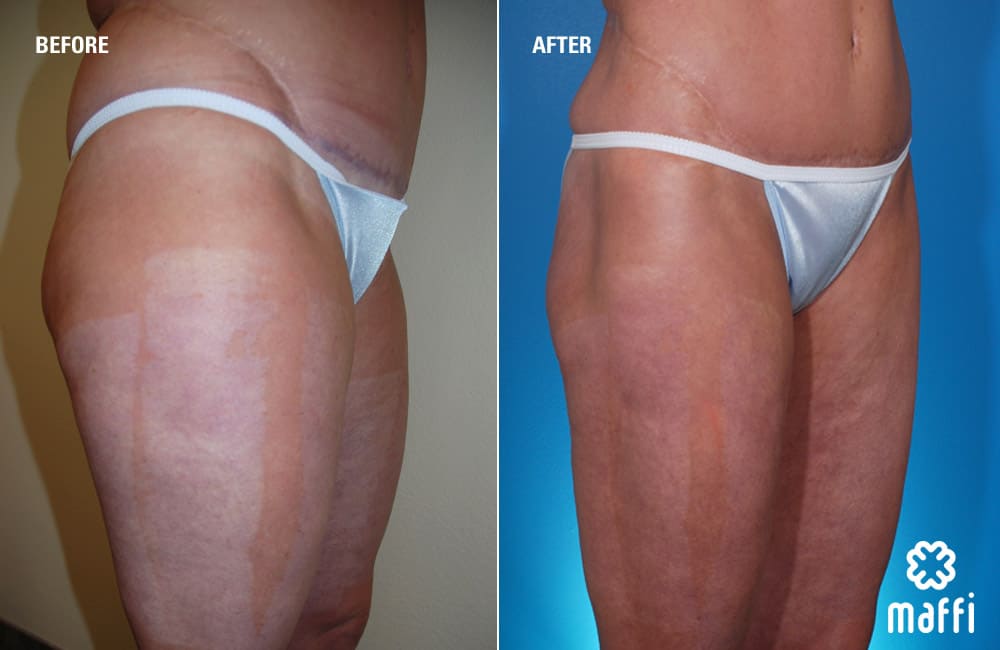 Before After Img