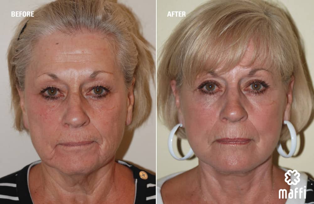 Before After Img