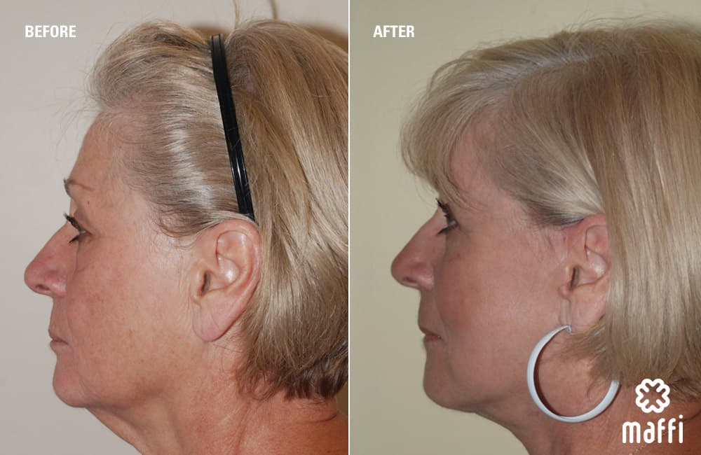 Before After Img