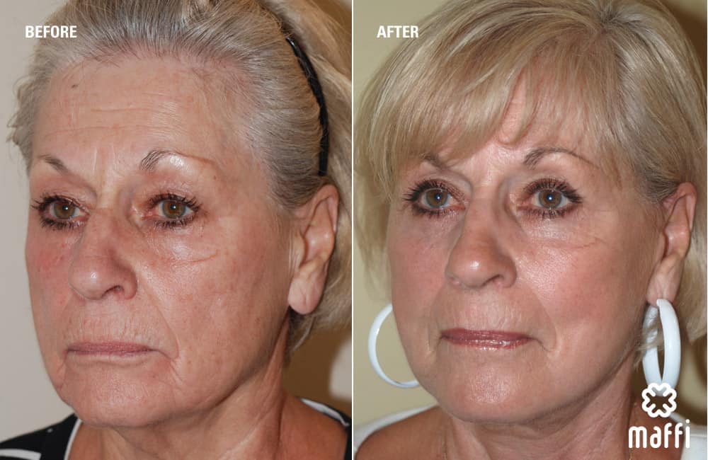 Before After Img