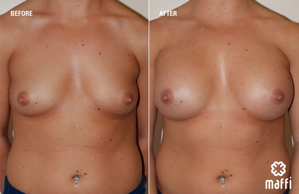 Before After Img