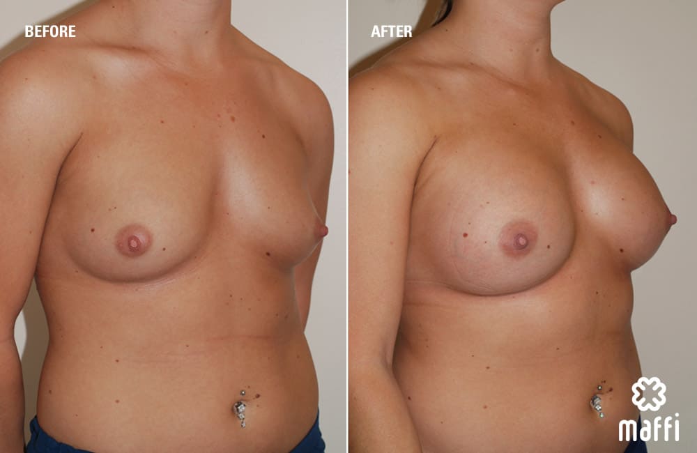 Before After Img