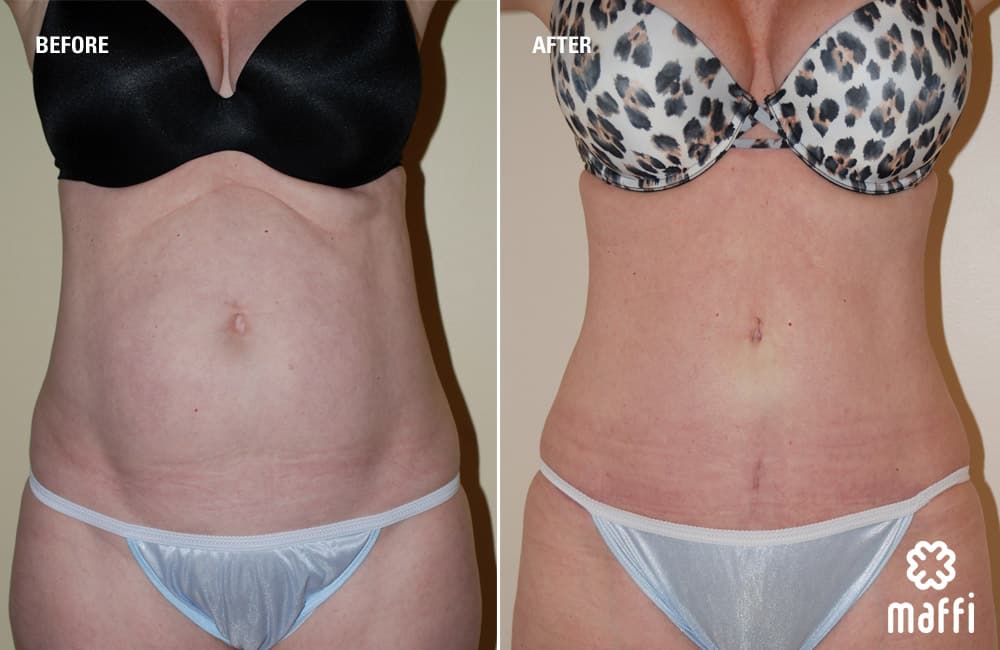 Before After Img