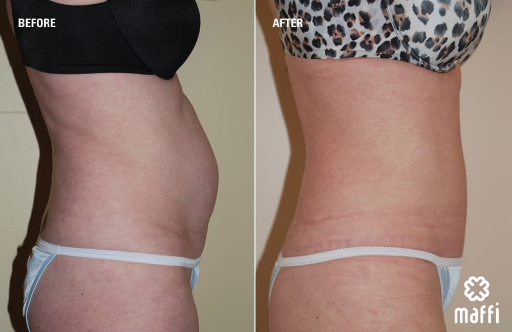 Before After Img