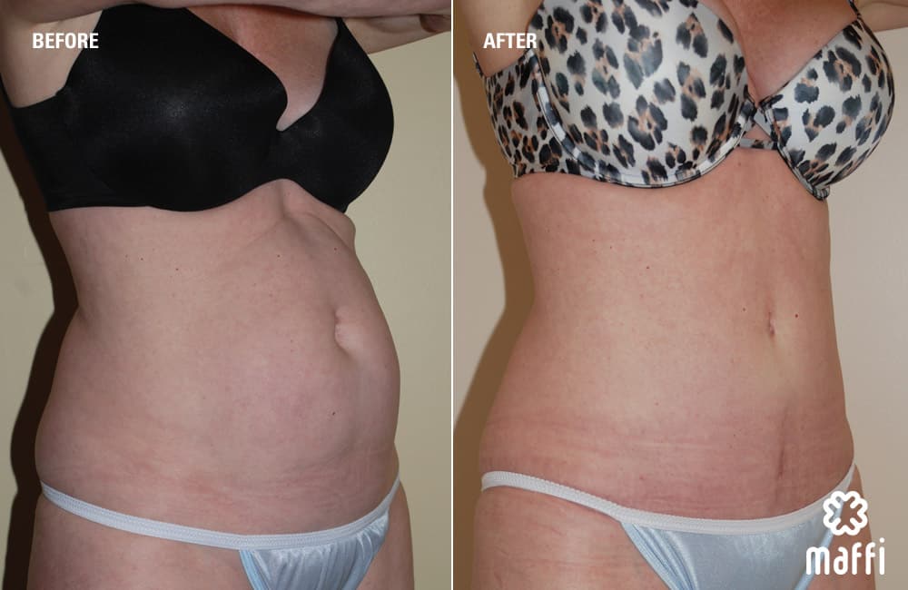 Before After Img