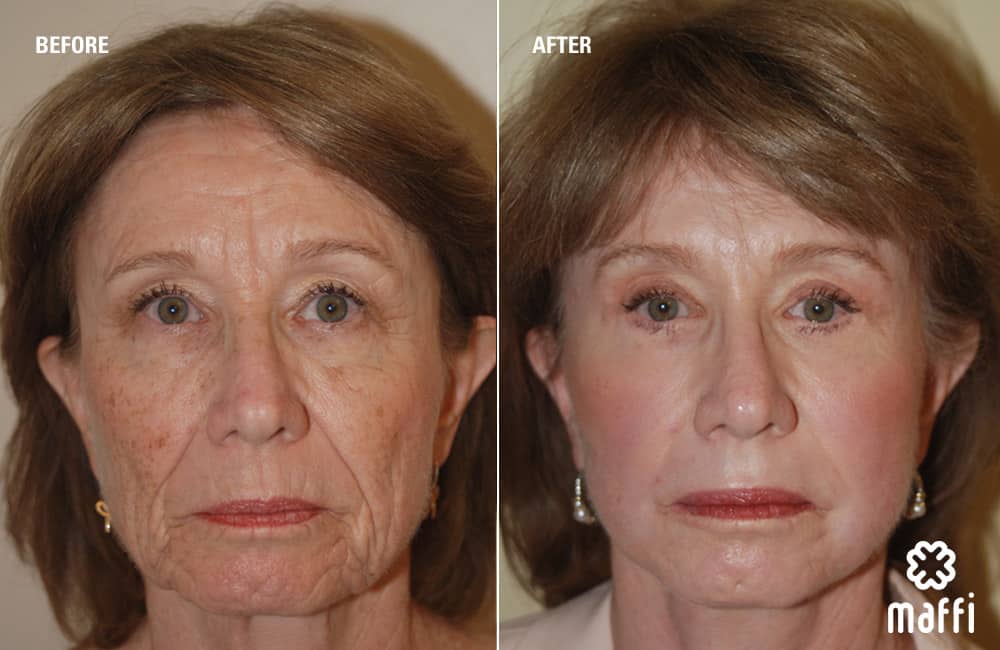 Before After Img