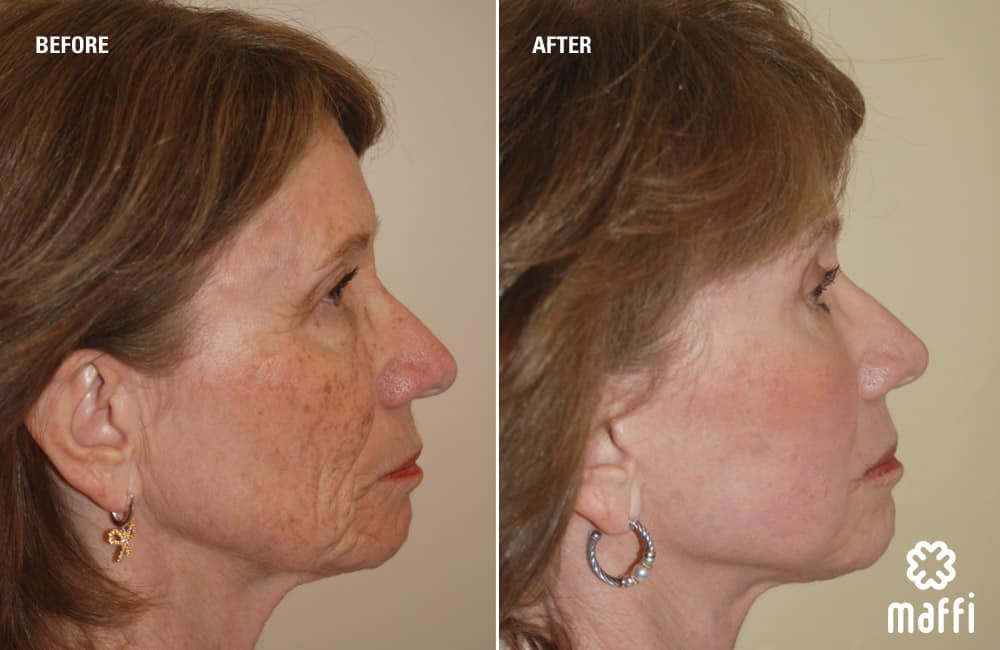 Before After Img