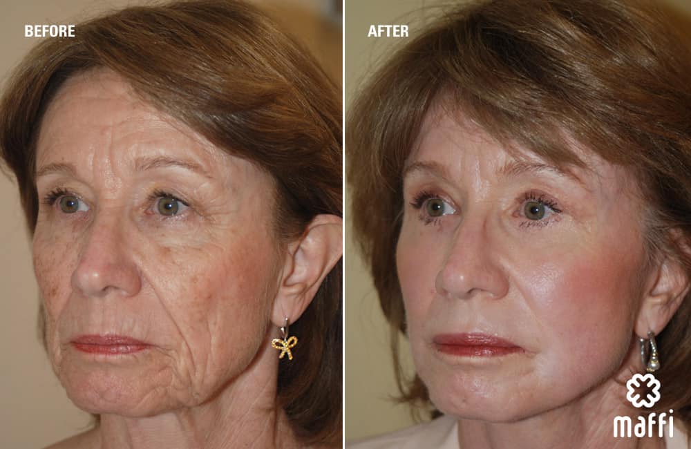 Before After Img